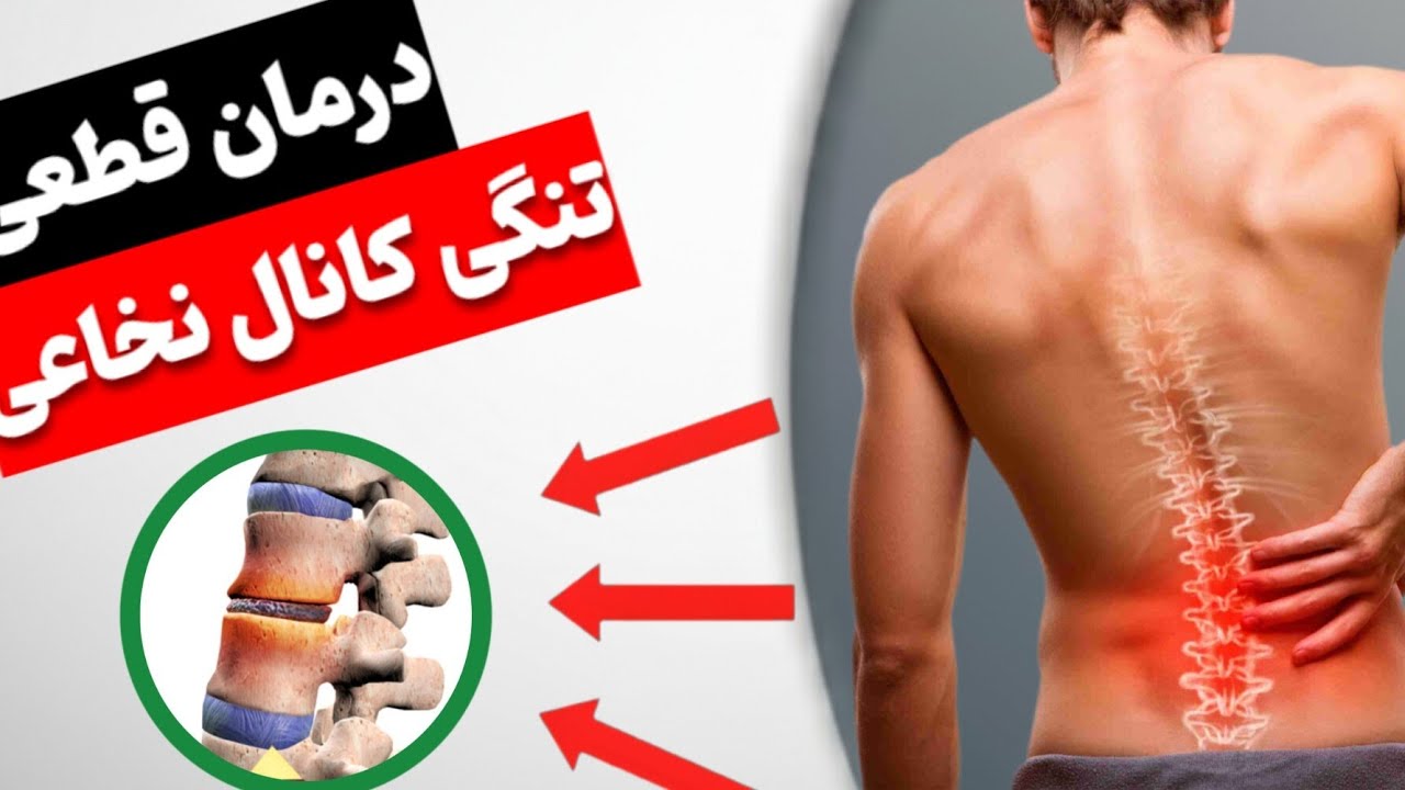 چطور کمردرد ناشی از تنگی کانال نخاعی رو در خانه درمان کنیم؟ راهکار فوری و قطعی