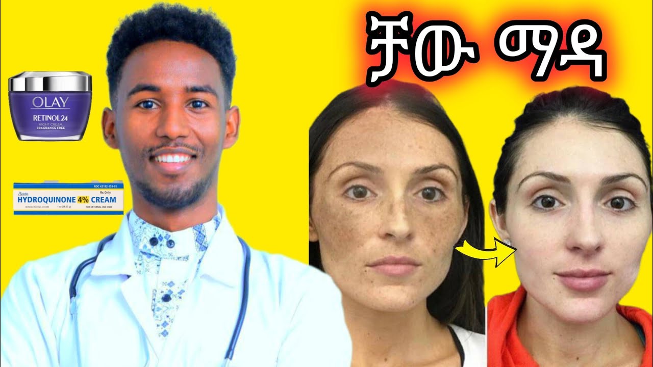 ማዳ ብኸመይ ክነጥፍኦ ንኽእል||How to Treat Melasma Effectively ||