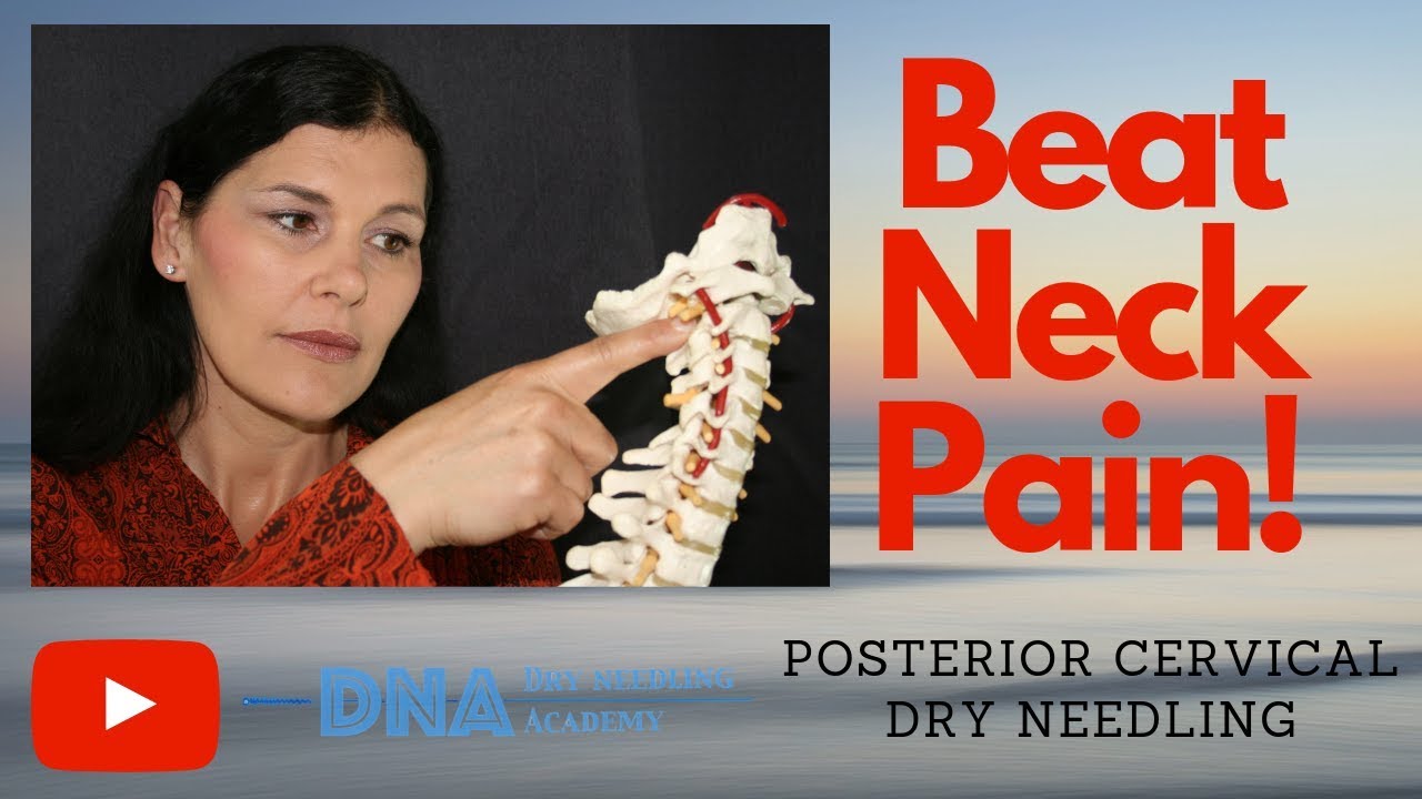 Dry Needling the Posterior Cervical Muscles