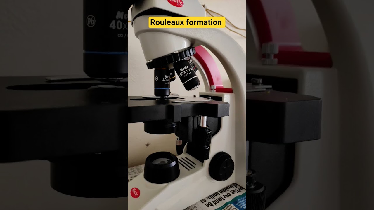 Rouleaux formation-it is the stacking of RBC, seen in inflammation, infections, some cancers.