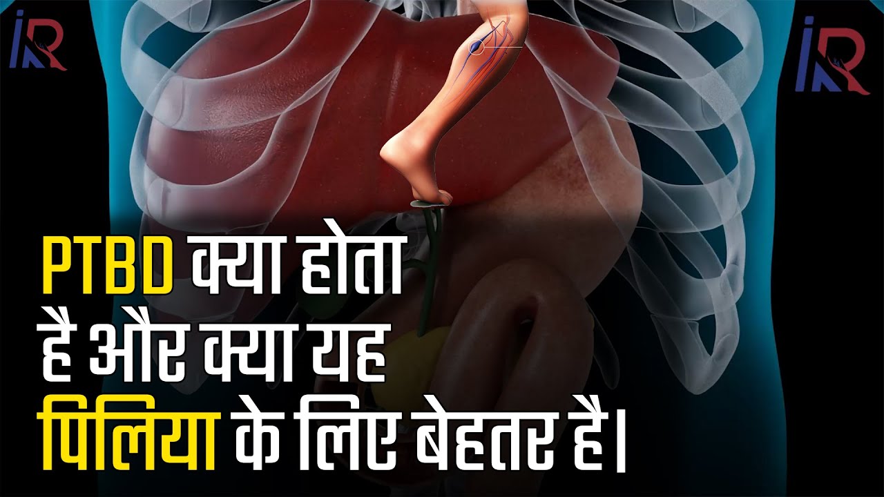 क्या आप जानते हैं PTBD क्या होता है और इस्से पिलिया को किस तरह काम किया जाता है #dralokkudiya #PTBD