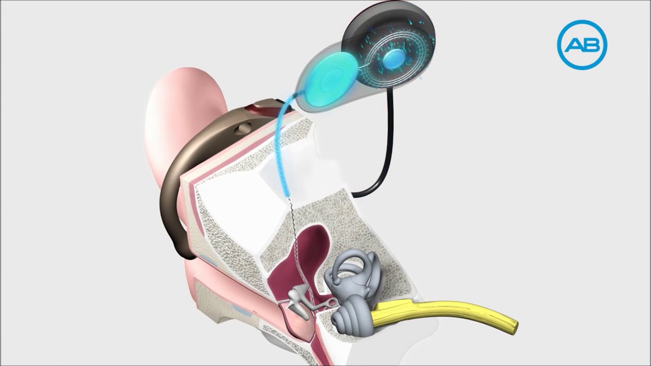 How A Cochlear Implant Works by Advanced Bionics