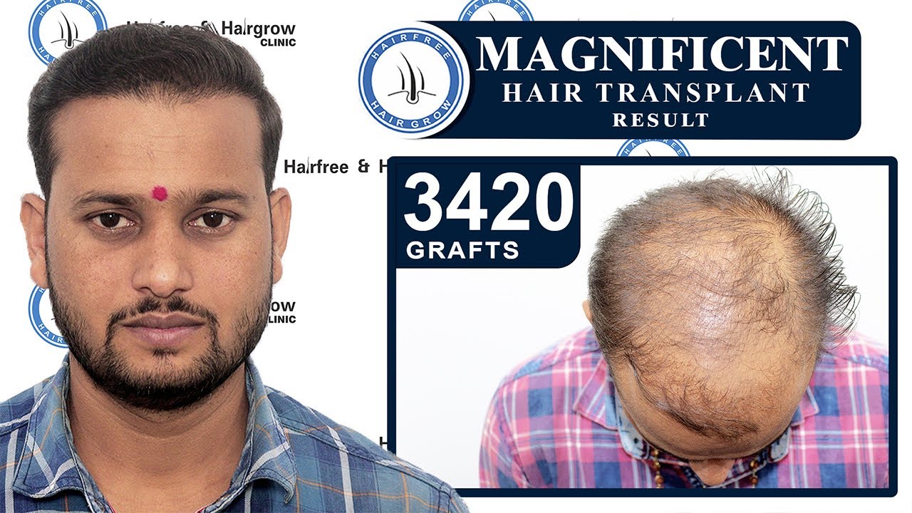 Magnificent Hair Transplant Result || Hair Transplant Before After || Advanced FUE Hair Transplant
