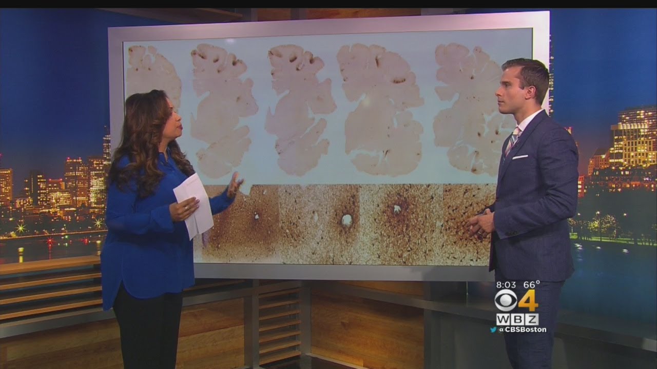 Dr. Marshall: CTE Can Cause Behavioral Problems