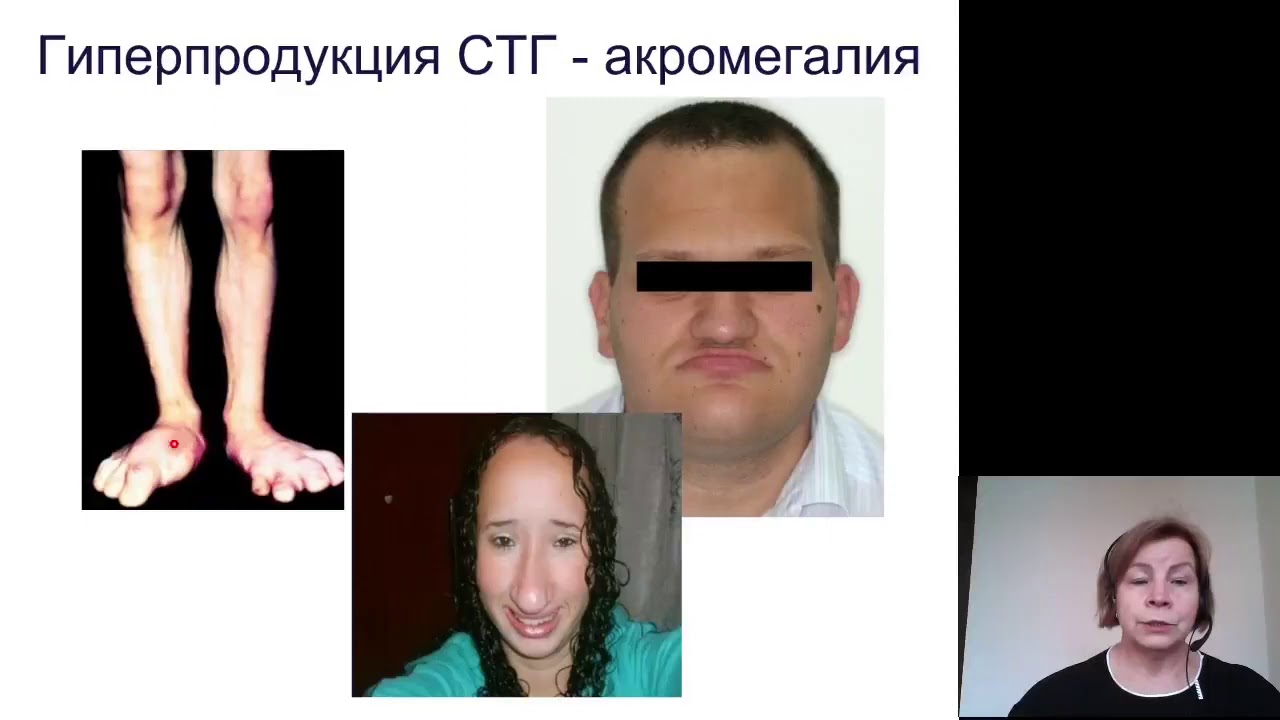 Пропедевтика детских болезней. Эндокринная система. Функциональные особенности, семиотика нарушений