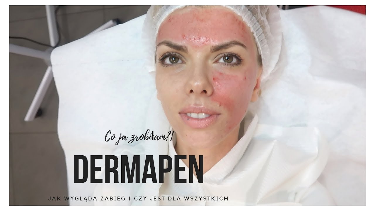 VLOG | Co ja zrobiłam?! Zabieg DERMAPEN | BEATA M