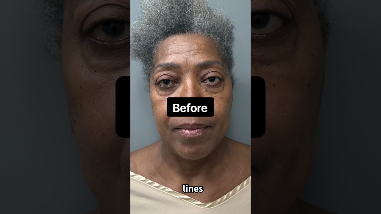 20 Years Removed! 🔥 #transformation #cosmeticsurgery #beforeandafter