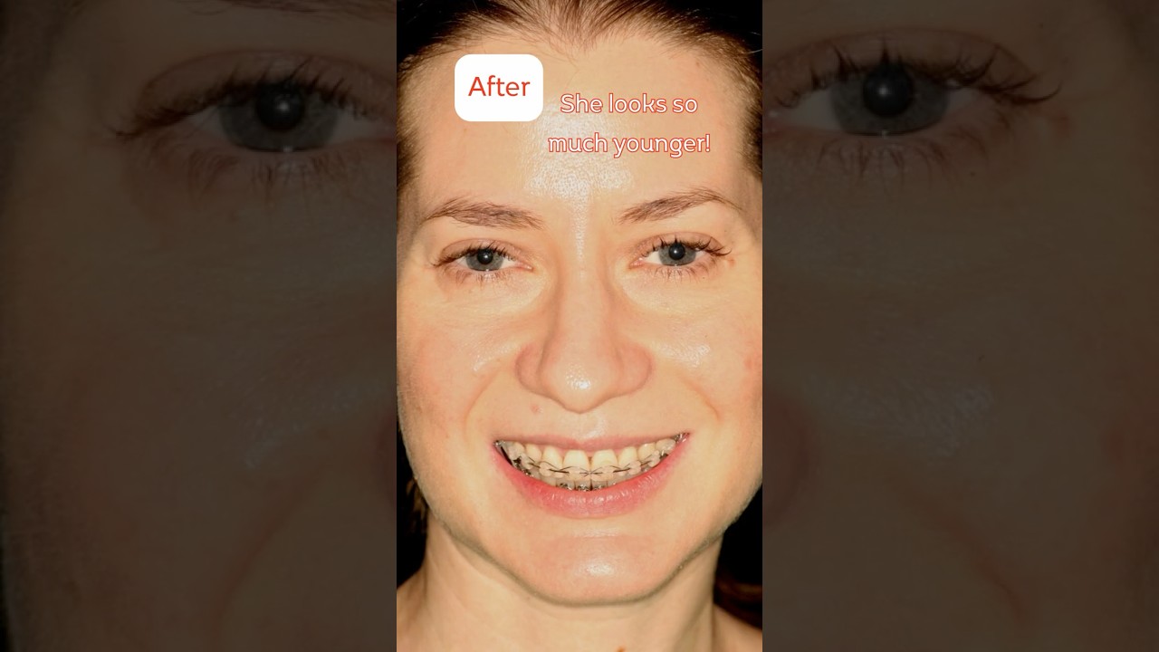 MSE - Adult palatal expansion, a real case in the post expansion, orthodontic phase.