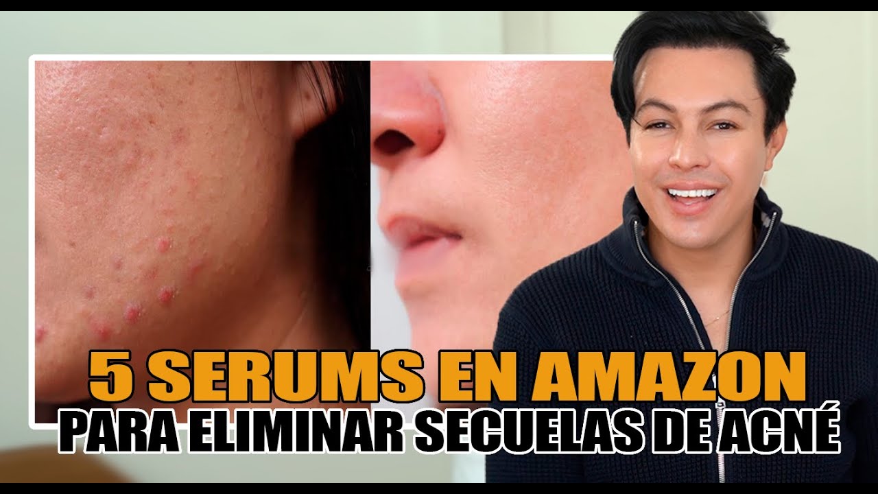 5 s&eacute;rums accesibles en Amazon que te ayudar&aacute;n a eliminar las cicatrices de acn&eacute;