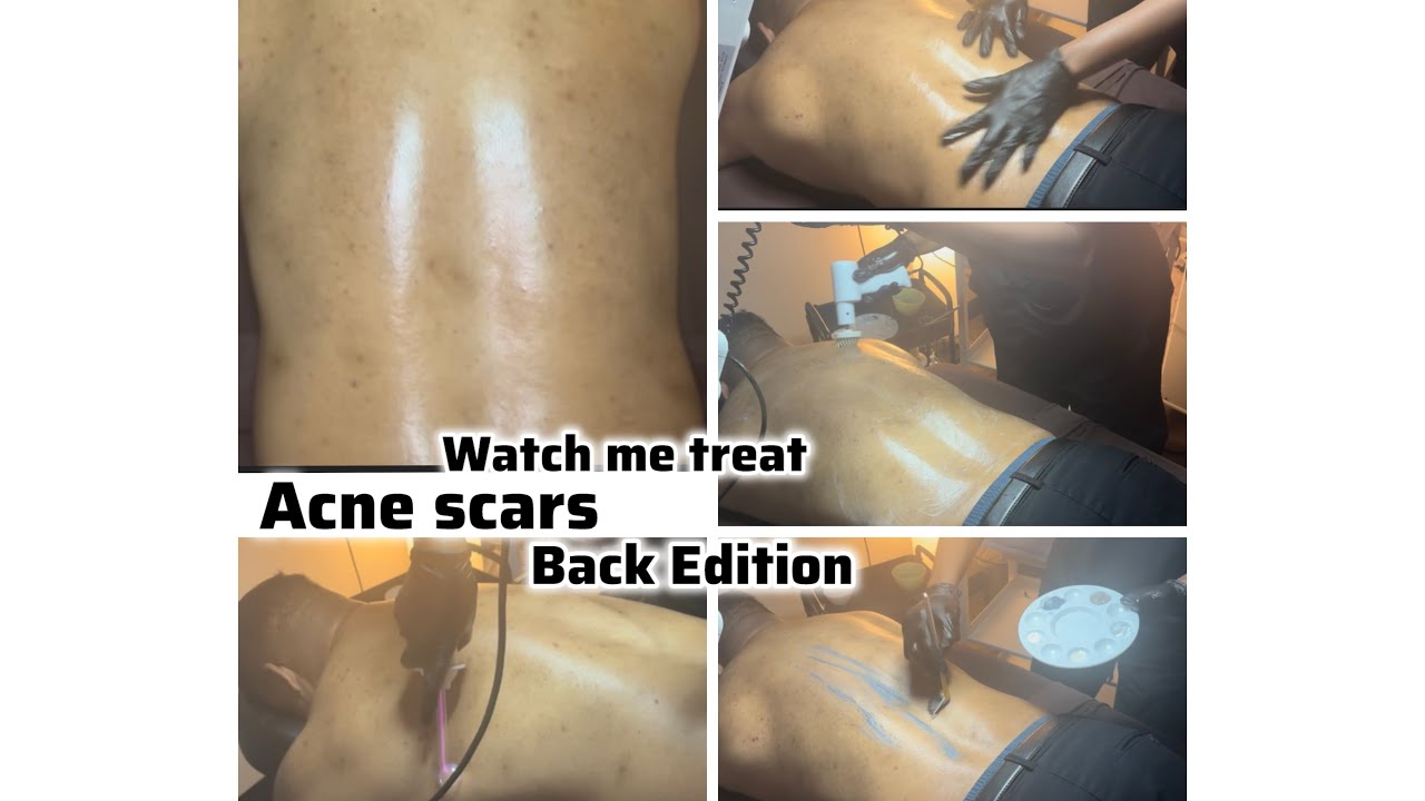 Watch Me Treat: Back Acne scars|  Maximum Hydration 