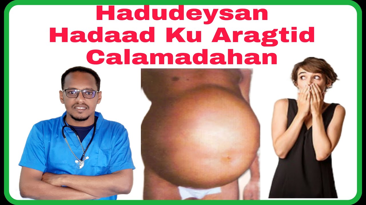 Ilmaha Ku Dhaca Cudurka Hepatitis A Calamadaha Lagu Garto Wax Yelada ugesan karo & Sida Lo Daweyo