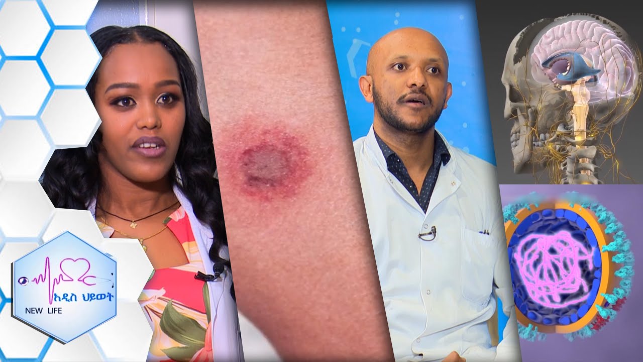 የጭርት መከላከያ ፤ “ኮቪድ ቫይረስ ነርቭ ላይ የሚፈጥረውን ችግር ለመከላከል መፍትሔው ……  ” /New Life Ep 343
