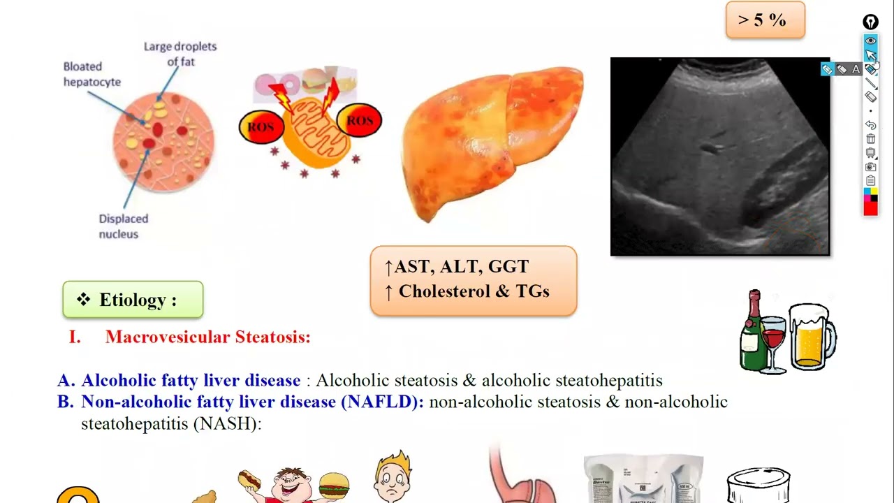 3-Chronic hepatitis & liver cirrhosis شرح باطنة دكتور سويلم