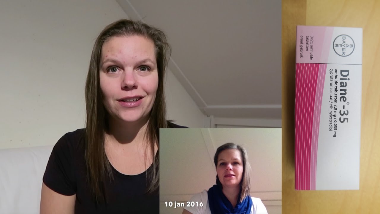 Stoppen met De Pil |  up- date / acne/  haaruitval/ afvallen