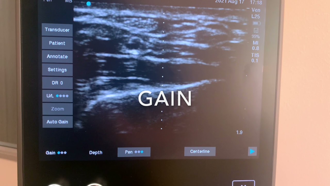 Sonosite S2 tutorial