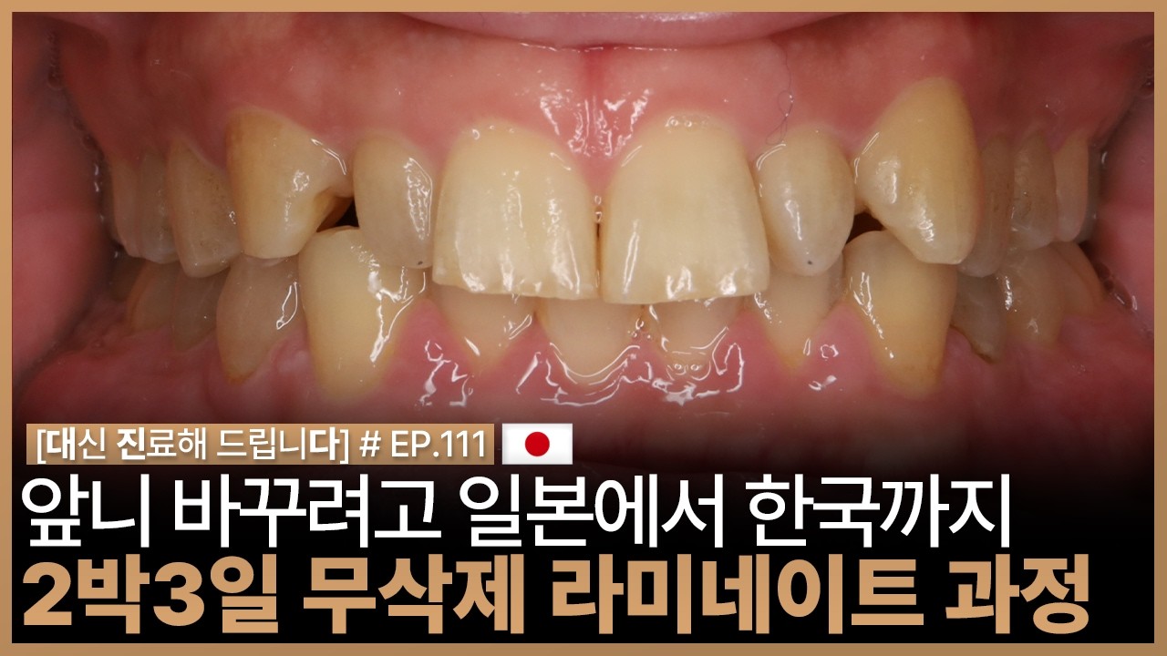 [대진다] 40대 일본 남성 무삭제 라미네이트│라미네이트 기간, 라미네이트 과정, 라미네이트 후기, 토끼치아, 왜소치 │EP.111