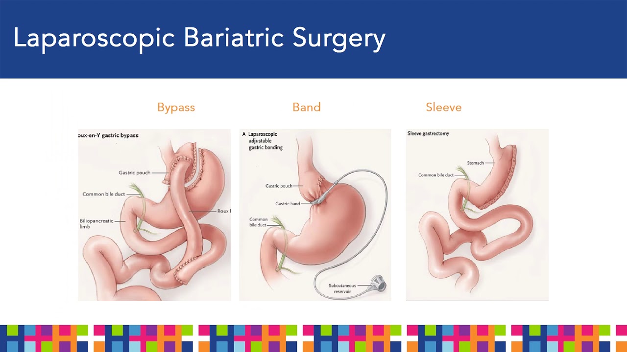Bellevue Bariatrics Information Seminar