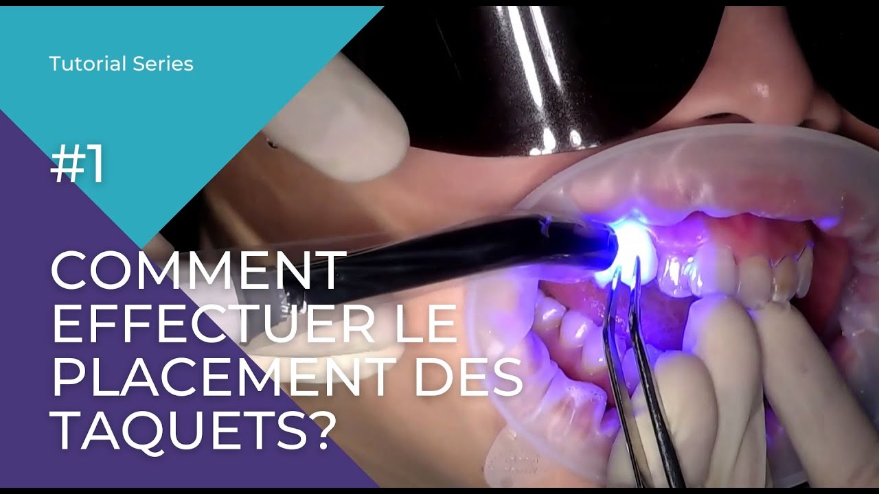 Comment effectuer le placement des taquets ?