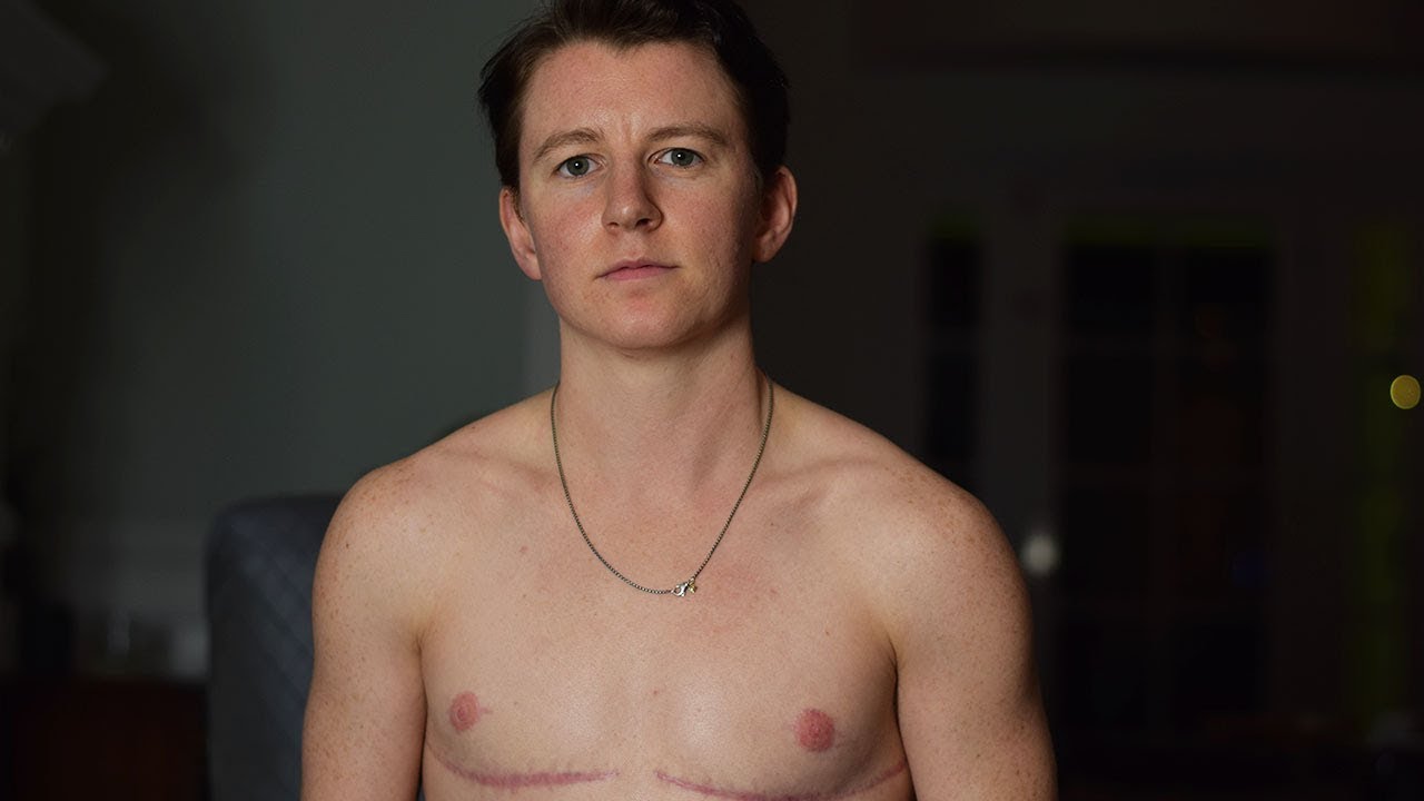 Post Op Chest Workout (6 months post op FTM) | Harrison Browne