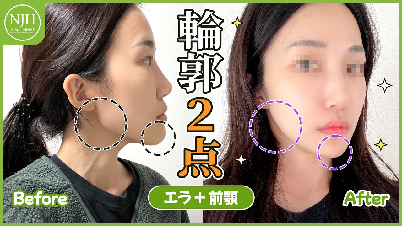 【輪郭形成】輪郭2点(エラ削り＋アゴ削り)で顔全体の骨格タイプを変える✨