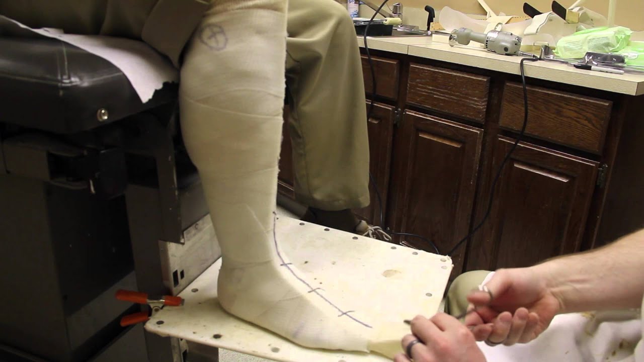 The Steps in Fabricating and Fitting a Custom AFO