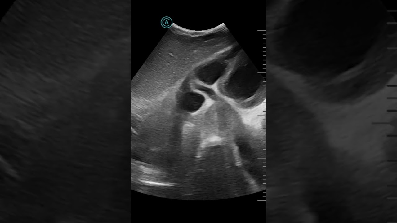 Heart case