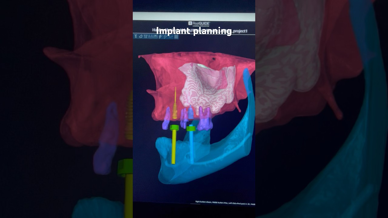 Implant planning and guided surgery by me for Dr. Haider #implant #realguides #blueskybio #3shape