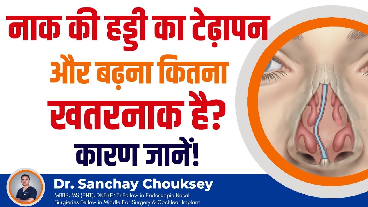 नाक की हड्डी का टेढ़ापन (Deviated Septum) | Naak Ki Haddi Ka Badhna | Naak Ki Haddi Ka ilaaj