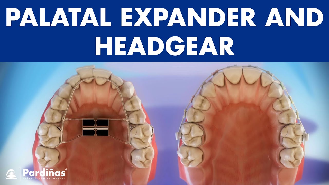 Orthodontic devices - Palatal expander and headgear ©
