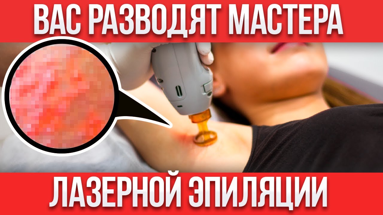 КОСМЕТОЛОГИ ВАС ОБМАНЫВАЮТ! / Как НАДУВАЮТ на лазерной эпиляции?
