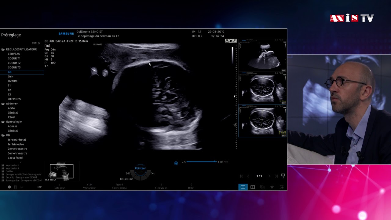 Cerveau foetal - Echographie de dépistage
