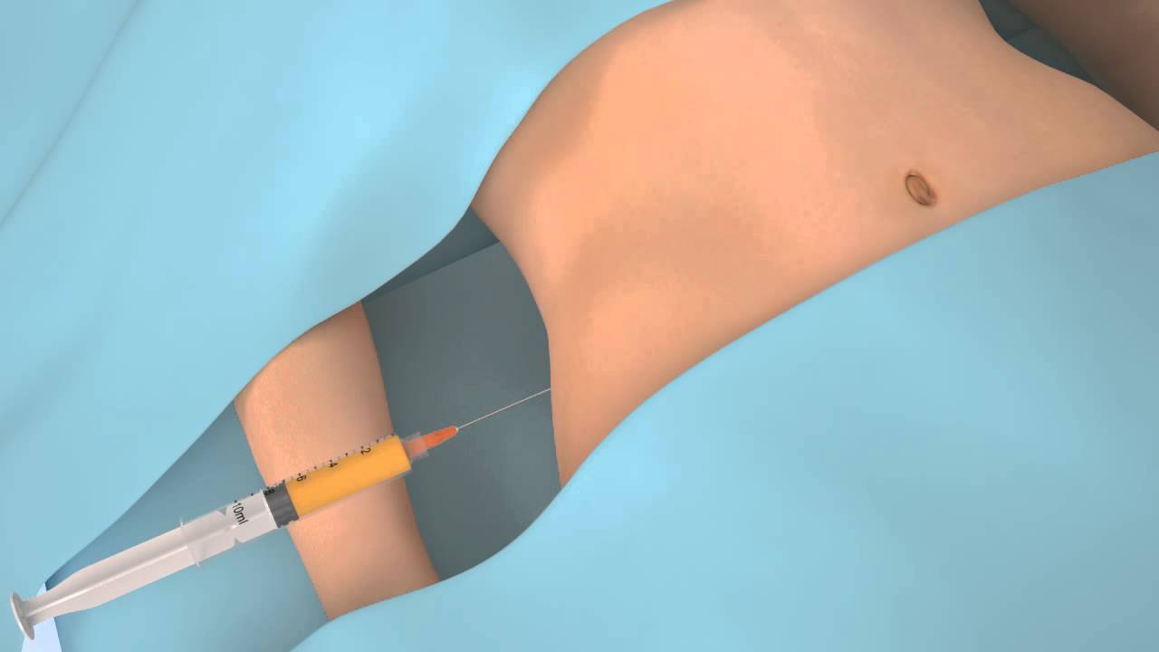 Stem Cells Animation for Non-surgical Spine & Orthopedics
