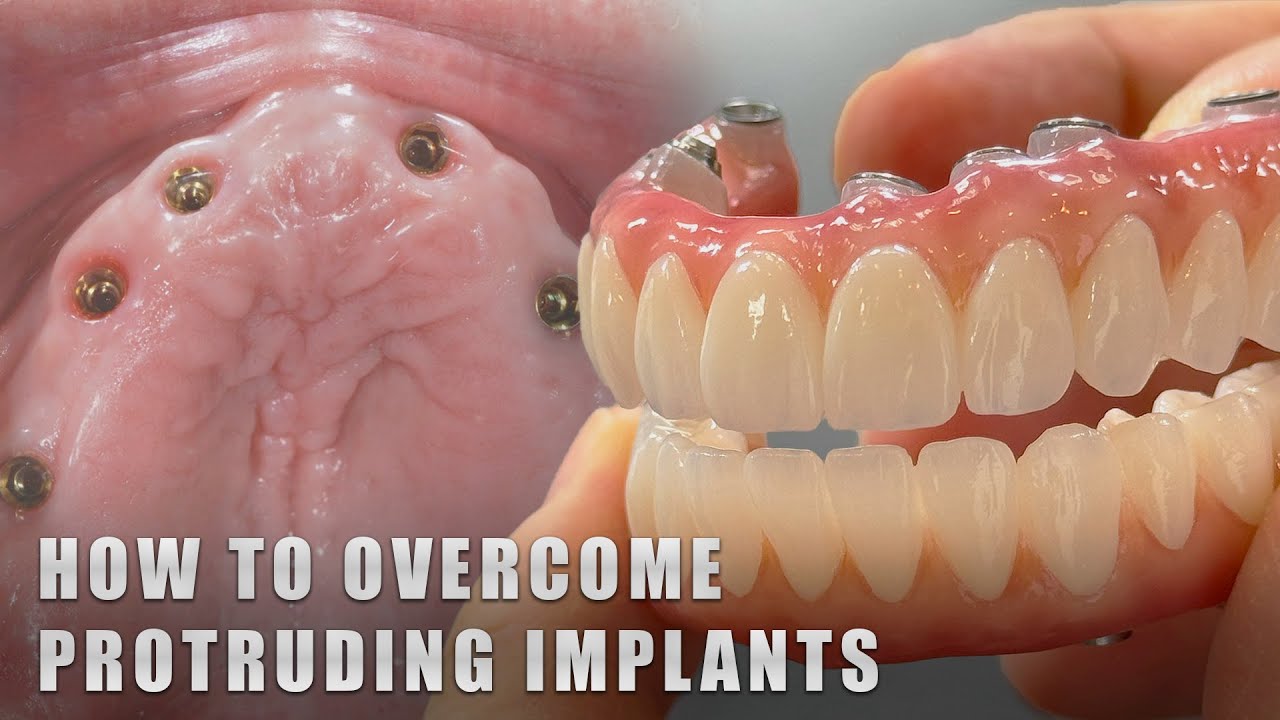 How to Overcome Protruding Implants