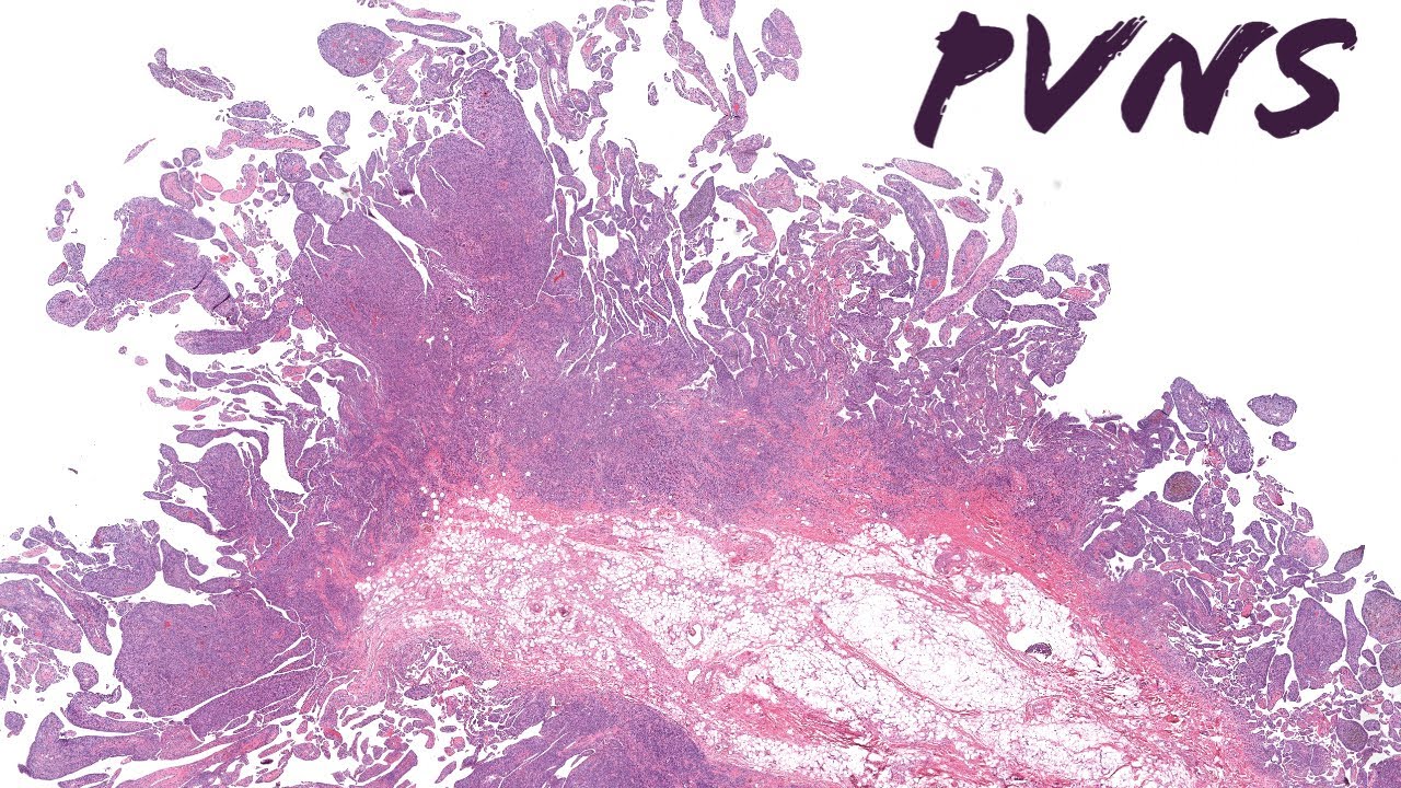 PVNS (pigmented villonodular synovitis/tenosynovial giant cell tumor diffuse type) pathology