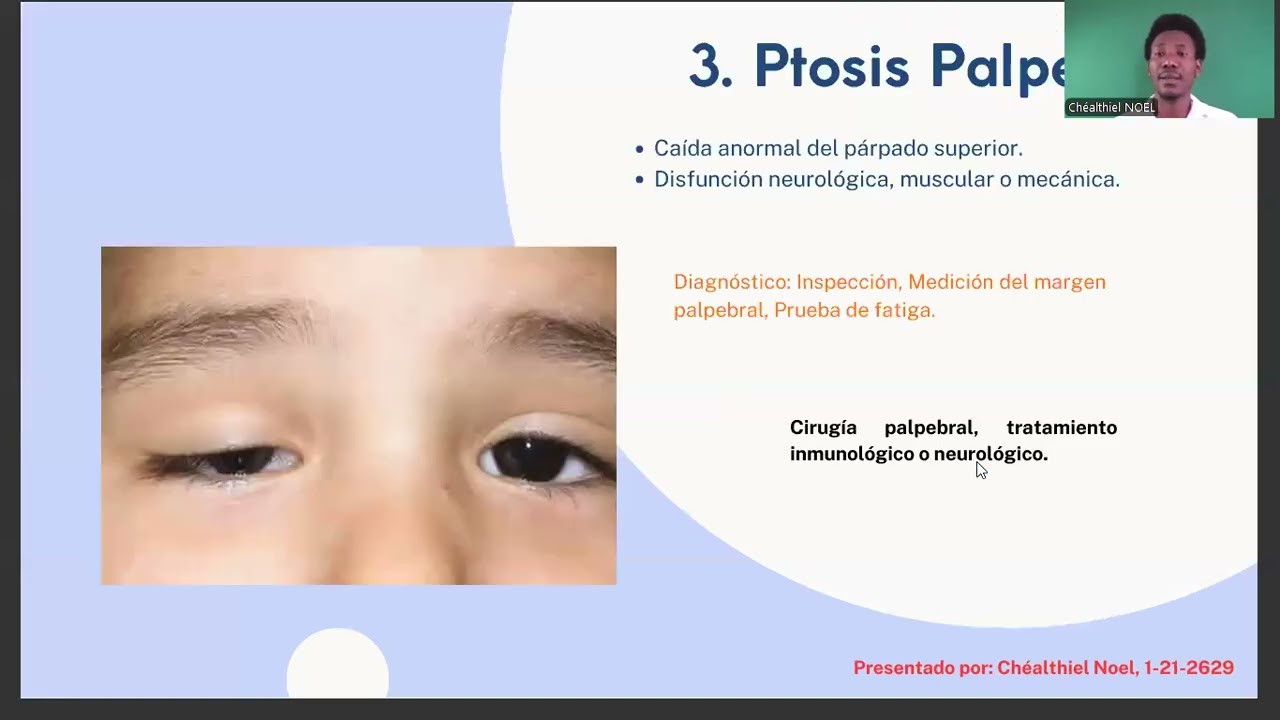 Diplopía. — Glaucoma. — Ptosis Palpebral.