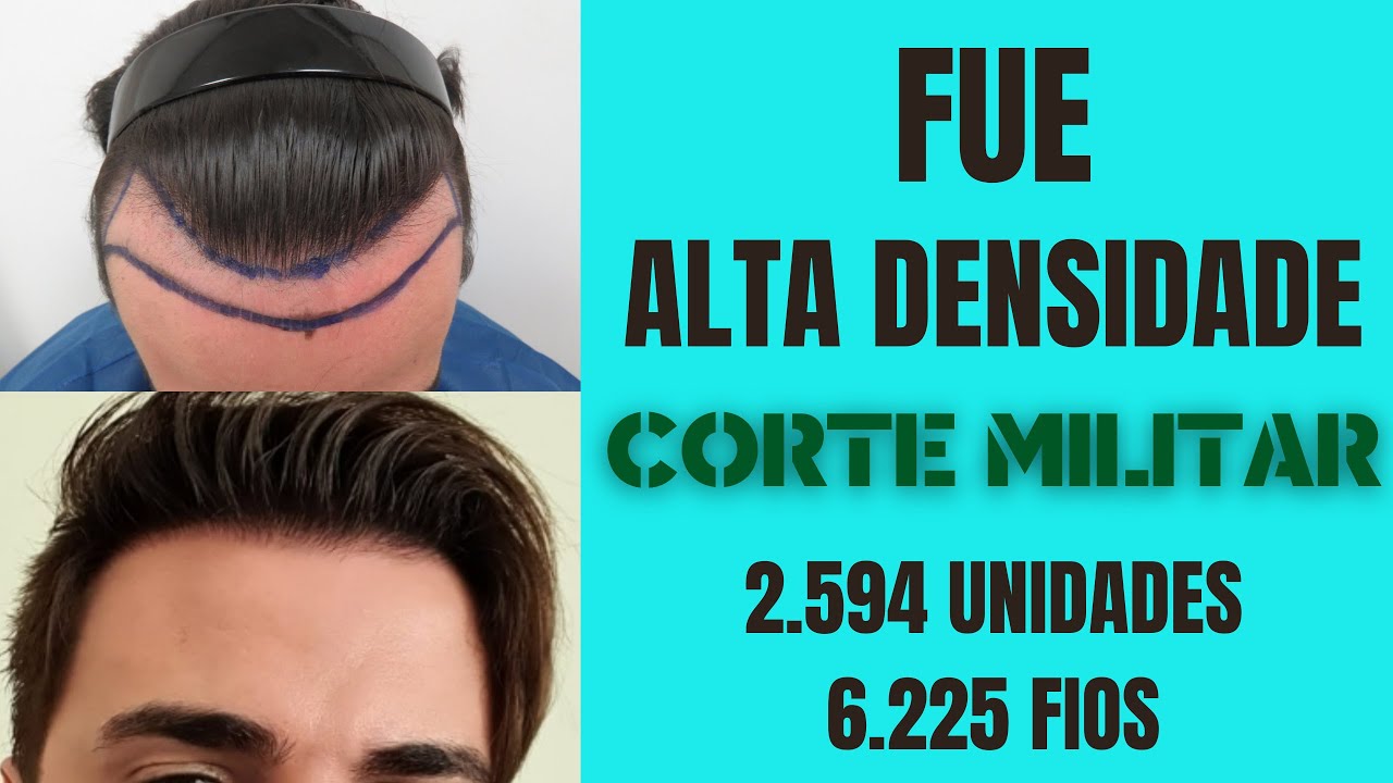 ALTA DENSIDADE - CORTE MILITAR | TRANSPLNTE CAPILAR FUE