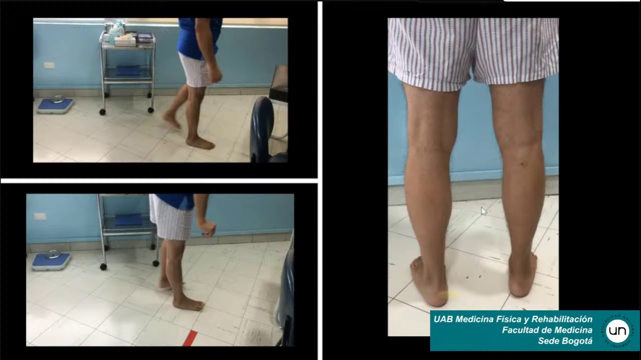 Neuropatía Ciática Bilateral