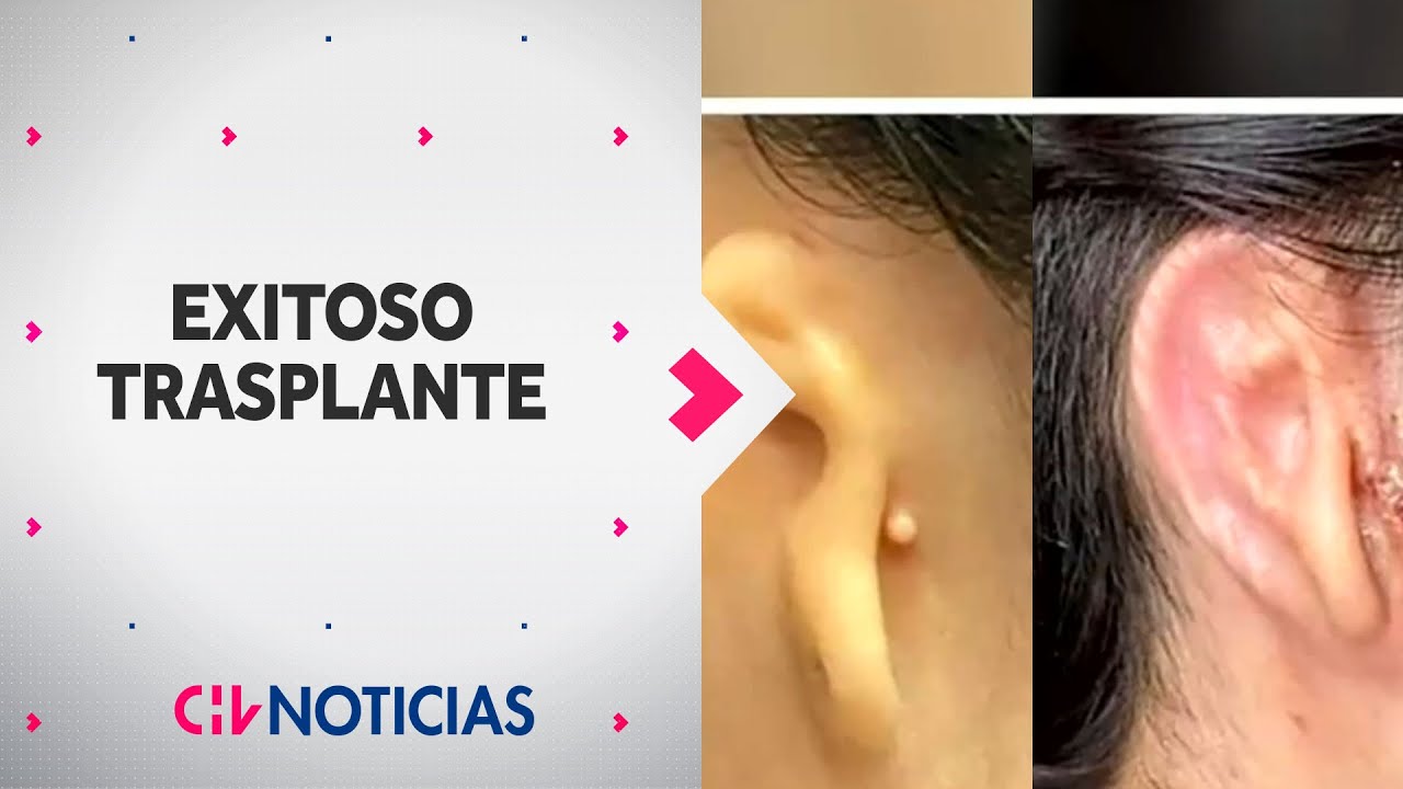 Mujer recibe EXITOSO TRASPLANTE con una oreja 3D: Así se realizó el procedimiento - CHV Noticias