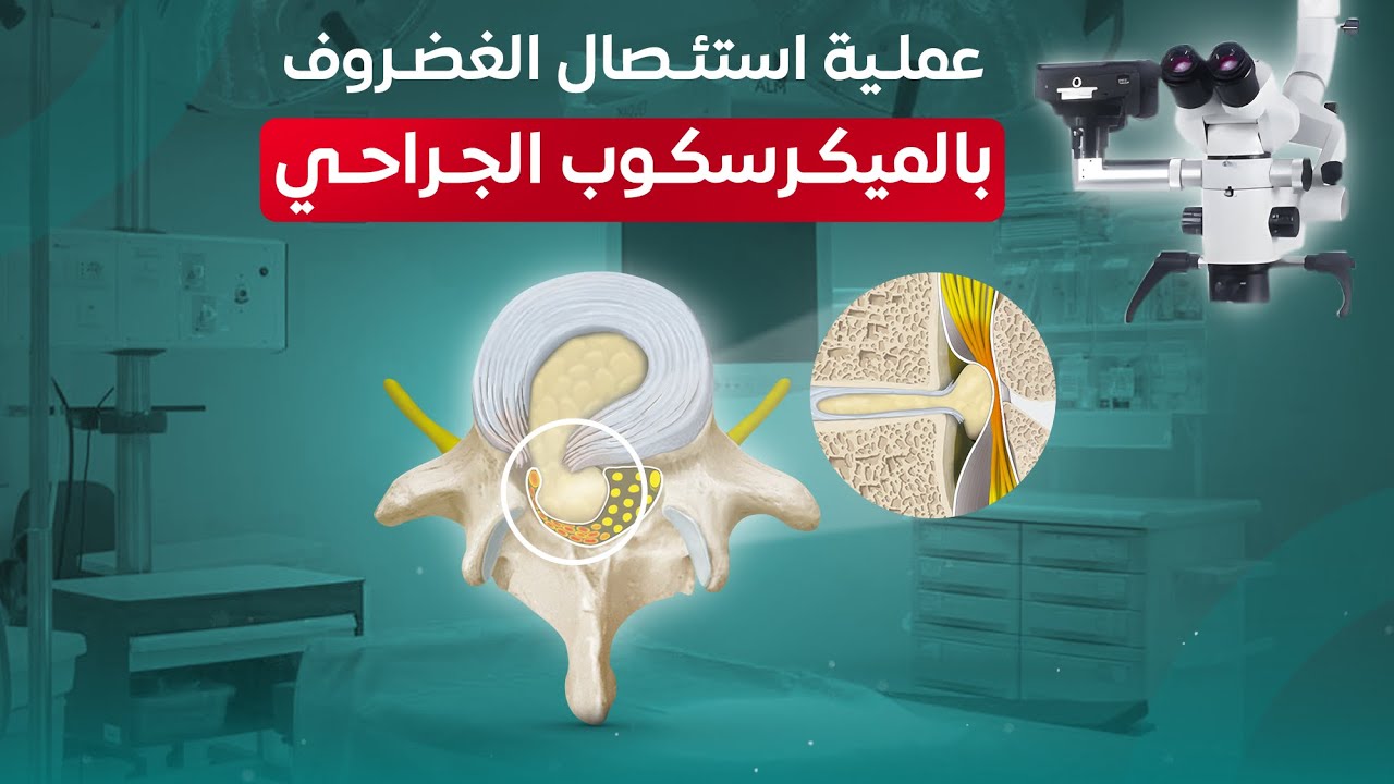 عملية الغضروف القطني بالميكروسكوب هى الحل لو العلاج ماجابش نتيجة - استئصال العضروف المنزلق