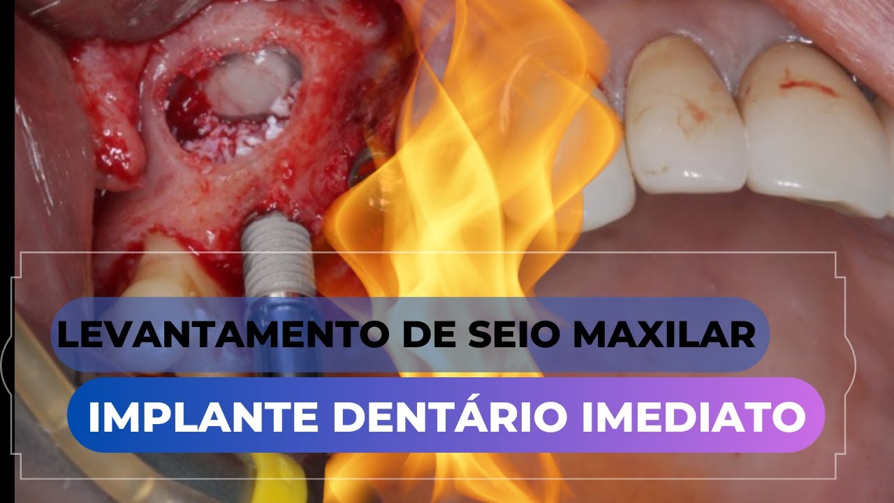 Levantamento de seio maxilar com implante dentário imediato. @dr.alexguedes