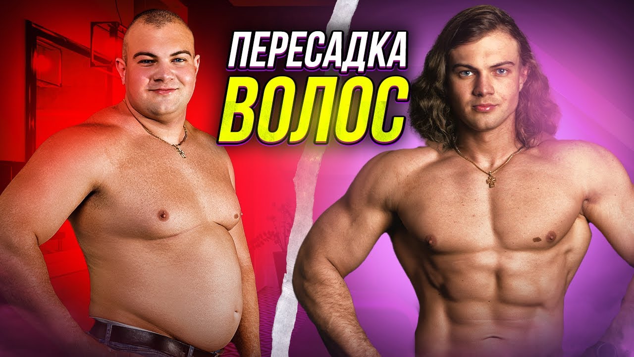 Пересадка волос в Турции методом DHI