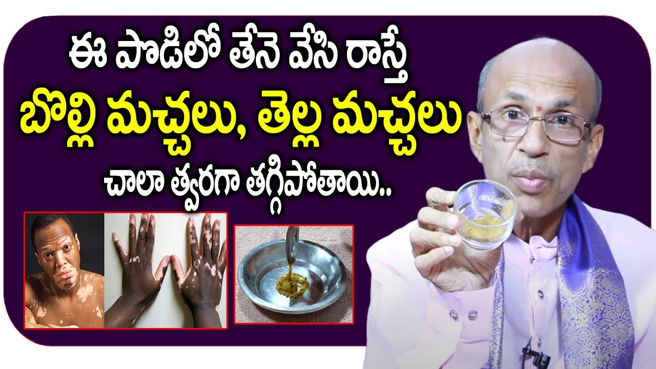 ఈ పొడిలో తేనెలో వేసి రాస్తే బొల్లి మచ్చలు శాశ్వతంగా తగ్గిపోతాయి || bolli machalu treatment in telugu
