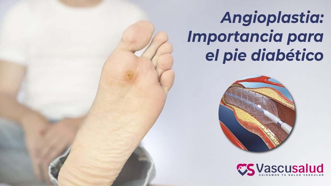 Angioplastia: Importancia para el pie diab&eacute;tico | Vascusalud