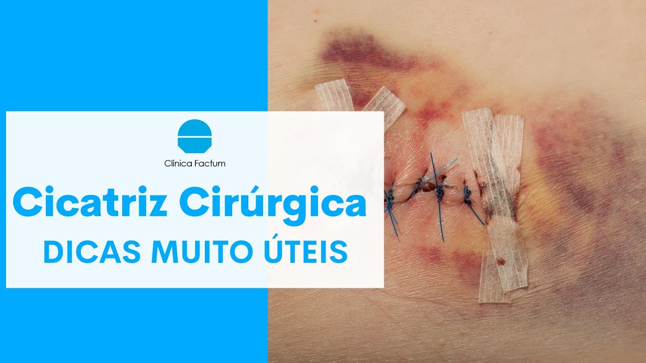 CICATRIZ CIRÚRGICA | dicas muito úteis!!