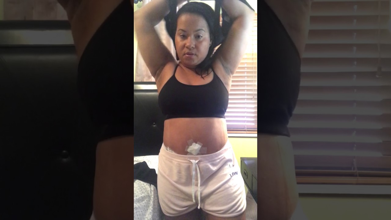 It's My (1) Month Post-Op Update!! (Sx 4/5/17) ~ Dr. Tania Medina - Santo Domingo (DR)