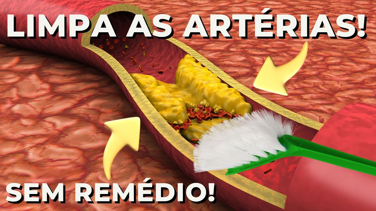 Soluções naturais para se livrar do infarto! Limpe as artérias!