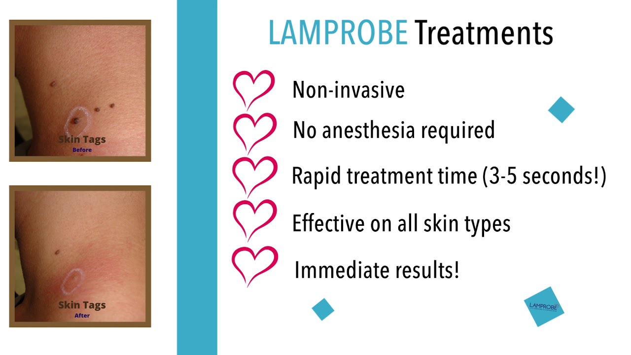 Lamprobe: Non-invasive, quick, effective, and painless!