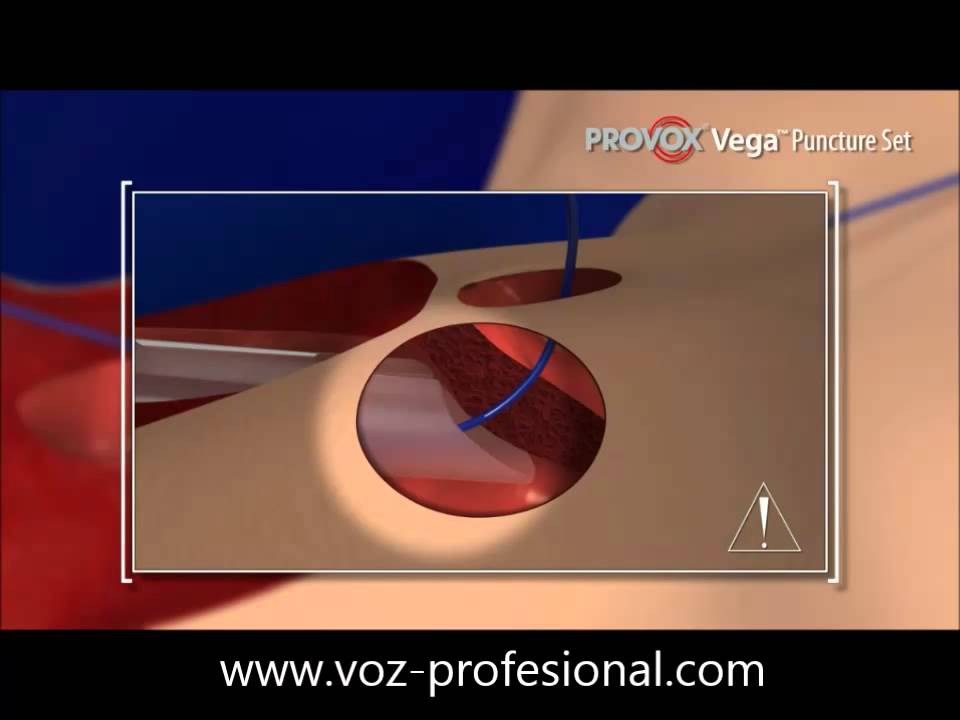 colocacion primaria de provox vega