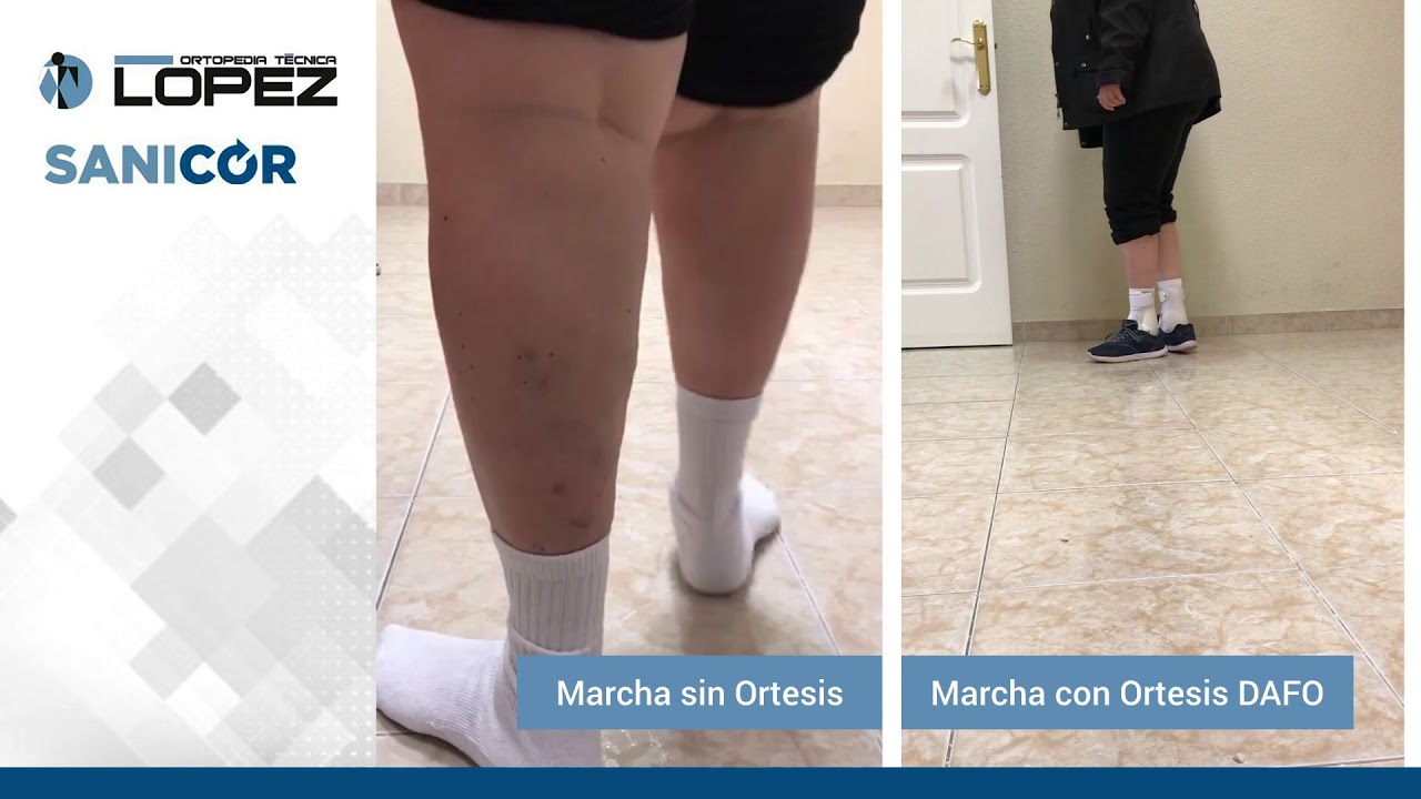 PIES PLANOS VALGOS ESTRUCTURADOS. MARCHA SIN ORTESIS VS CON ORTESIS DAFO Ortopedia López Jaén