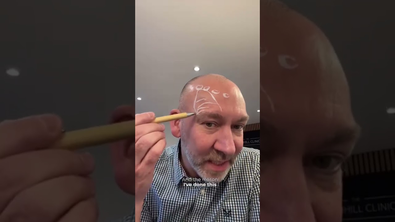 Botulinum Brow Drop